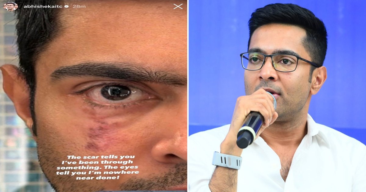 ‘লড়াই এখনও শেষ হয়নি’, আমেরিকা থেকে চোখের ক্ষতচিহ্নের ছবি পোস্ট করে বার্তা অভিষেক বন্দ্যোপাধ্যায়ের